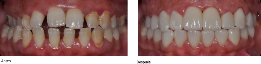 imagen carillas de porcelana